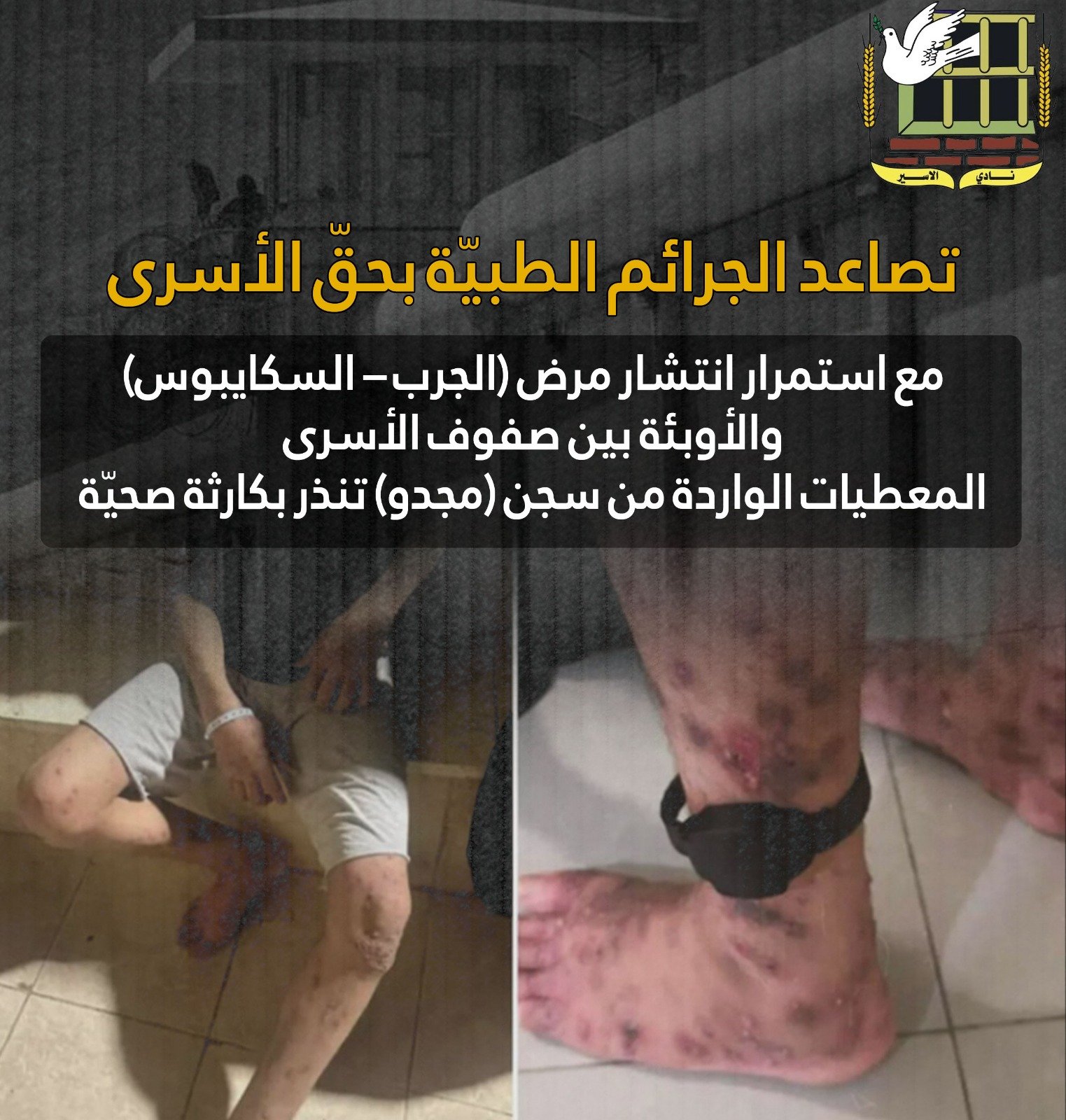 نادي الاسير: استمرار انتشار مرض الجرب "السكابيوس" في صفوف الاسرى